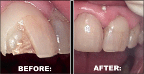 Dental Bridges Dental Bridges