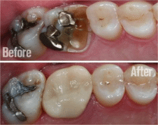 Dental Crowns Dental Crowns